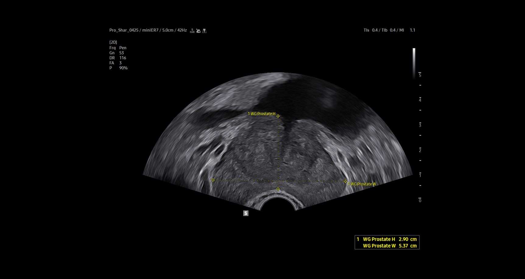 Transrectal ultrasound image of the prostate using ProstateAssist showing automated prostate measurements with yellow calipers and dimension annotations overlaid on a cross-sectional grayscale view to aid in efficient assessment