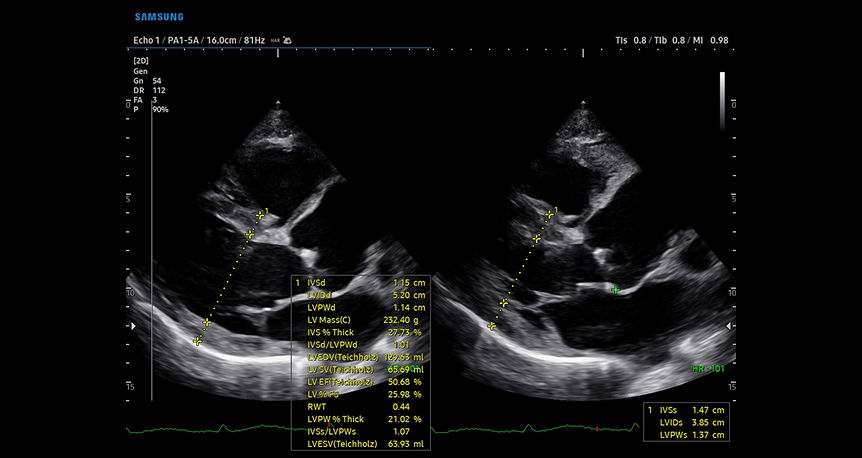 HeartAssist AI-powered cardiac measurement tool providing automatic classification of ultrasound images with precise dimensional analysis and side-by-side comparison views