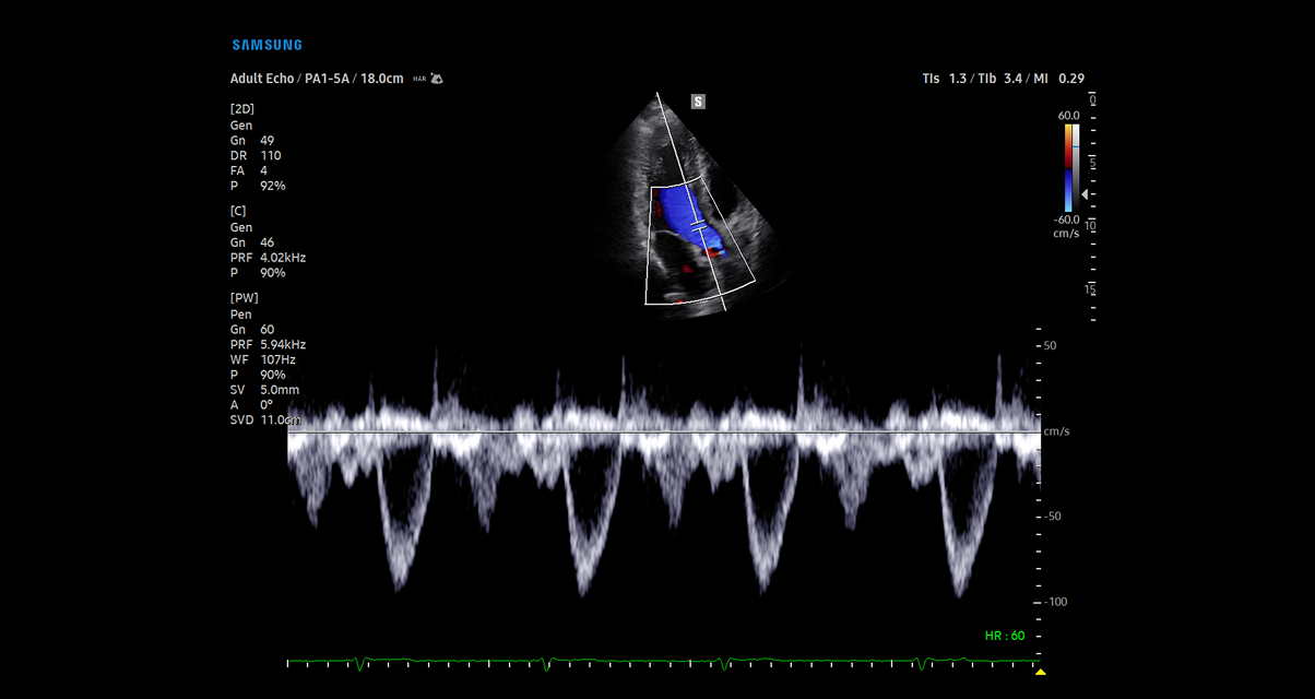 PulsedWave Doppler in LVOT view on Samsung cV Ultrasound machine showing detailed cardiovascular waveform analysis with precise hemodynamic assessment