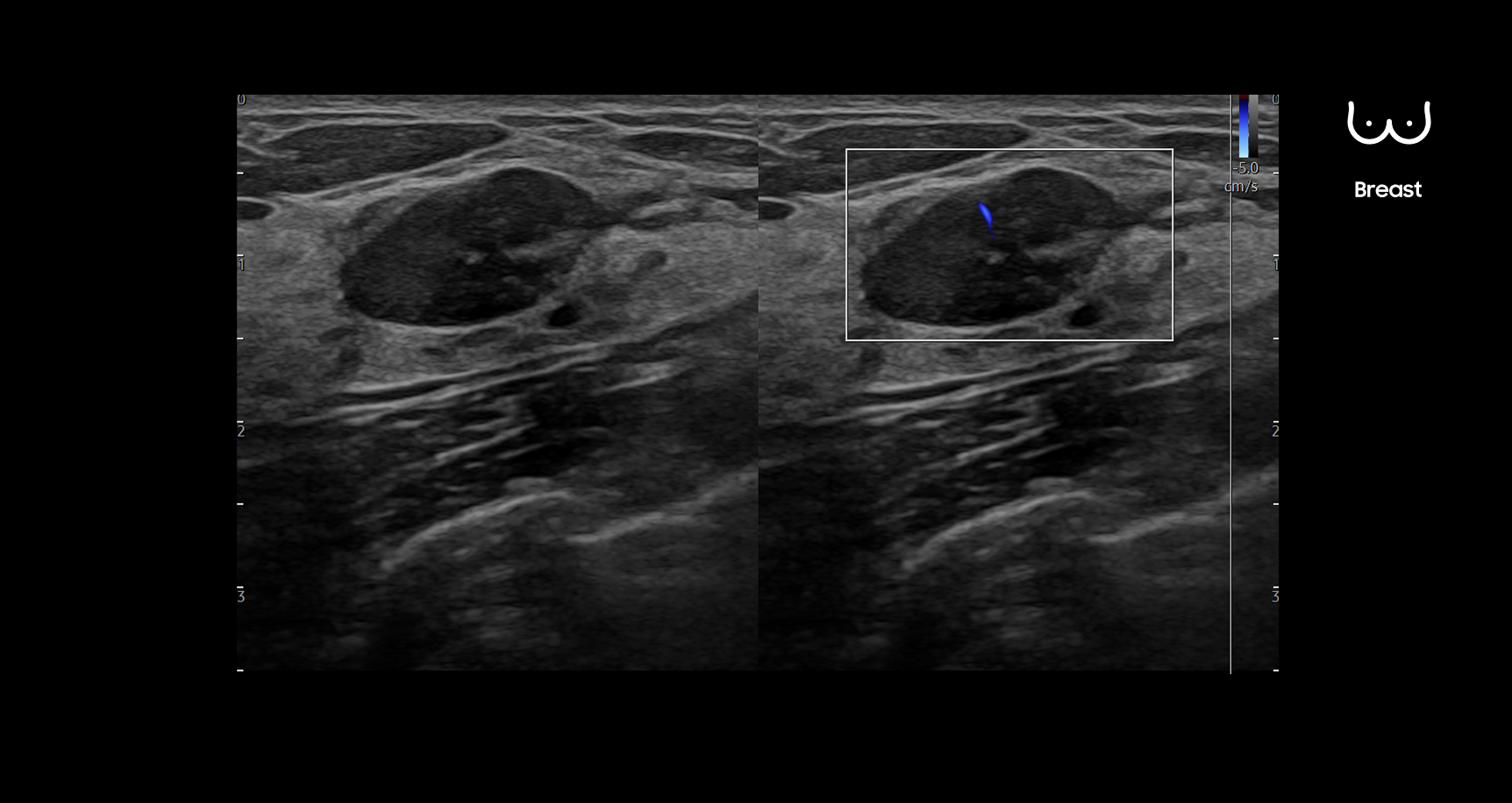 Dual-panel breast ultrasound image using Live BreastAssist showing a lesion detected and highlighted with a rectangular region of interest and a marker to assist healthcare professionals in diagnosis