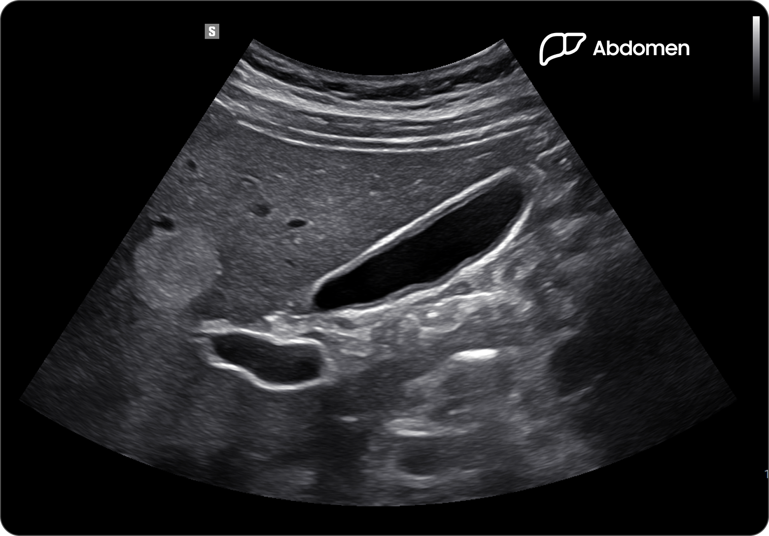 Ultrasound image of gallbladder and liver hemangioma using 3rd Harmonic for improved clarity and contrast