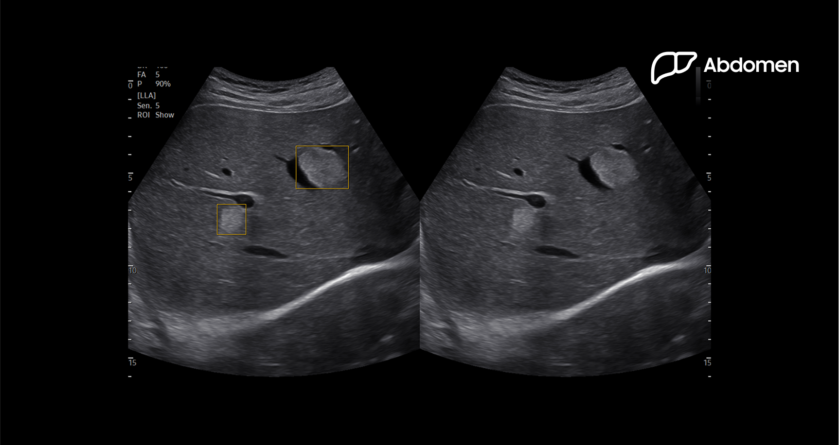Dual-panel abdominal ultrasound image using Live LiverAssist showing the liver with highlighted regions of interest and vascular structures in grayscale