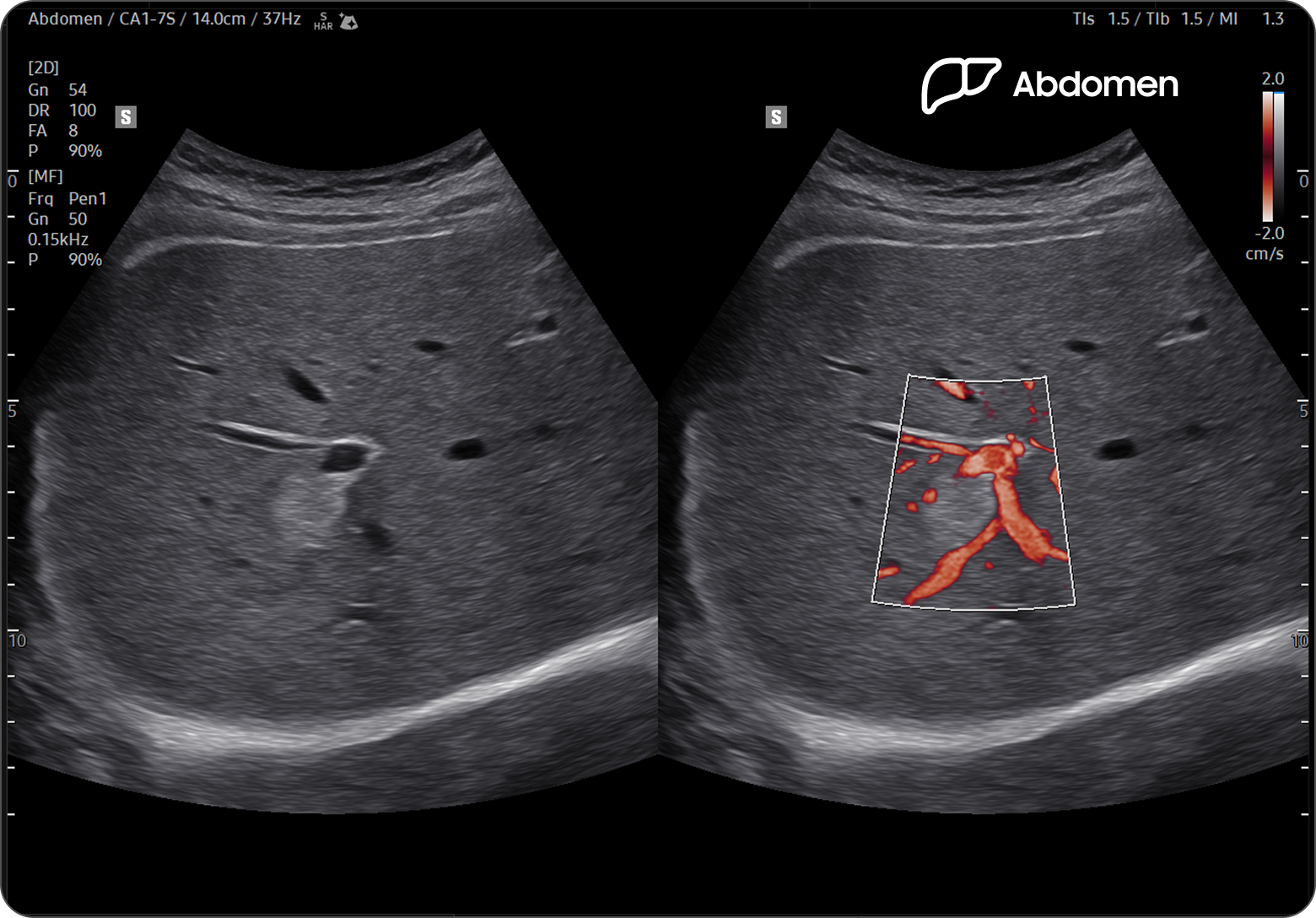 Ultrasound image of the liver showing hemangioma with MV-Flow highlighting blood flow in red within the lesion