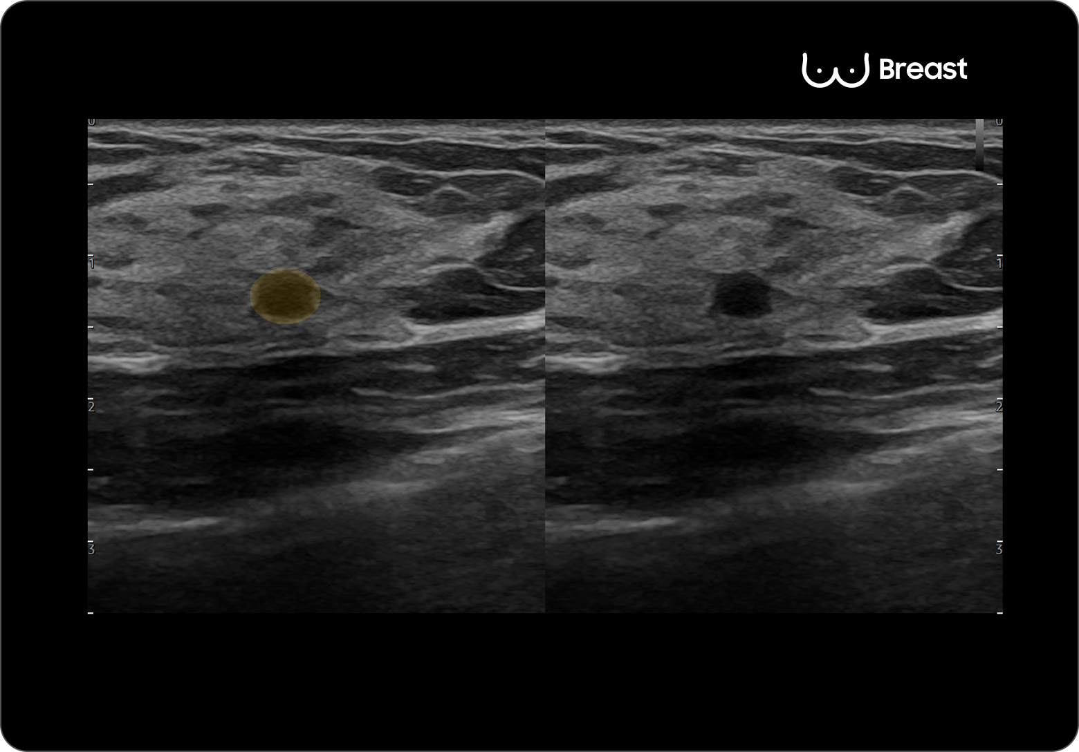 Breast ultrasound image comparing a mass with and without Live BreastAssist assistance highlighting lesion boundaries