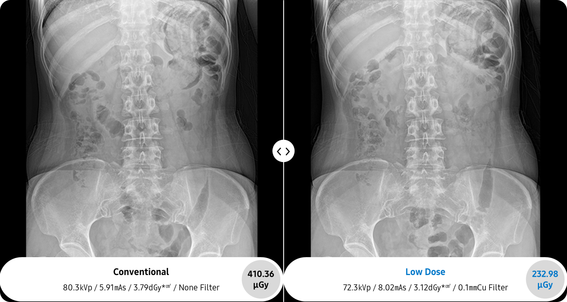 X-ray image of a pediatric abdomen taken by GC85A x-ray machine