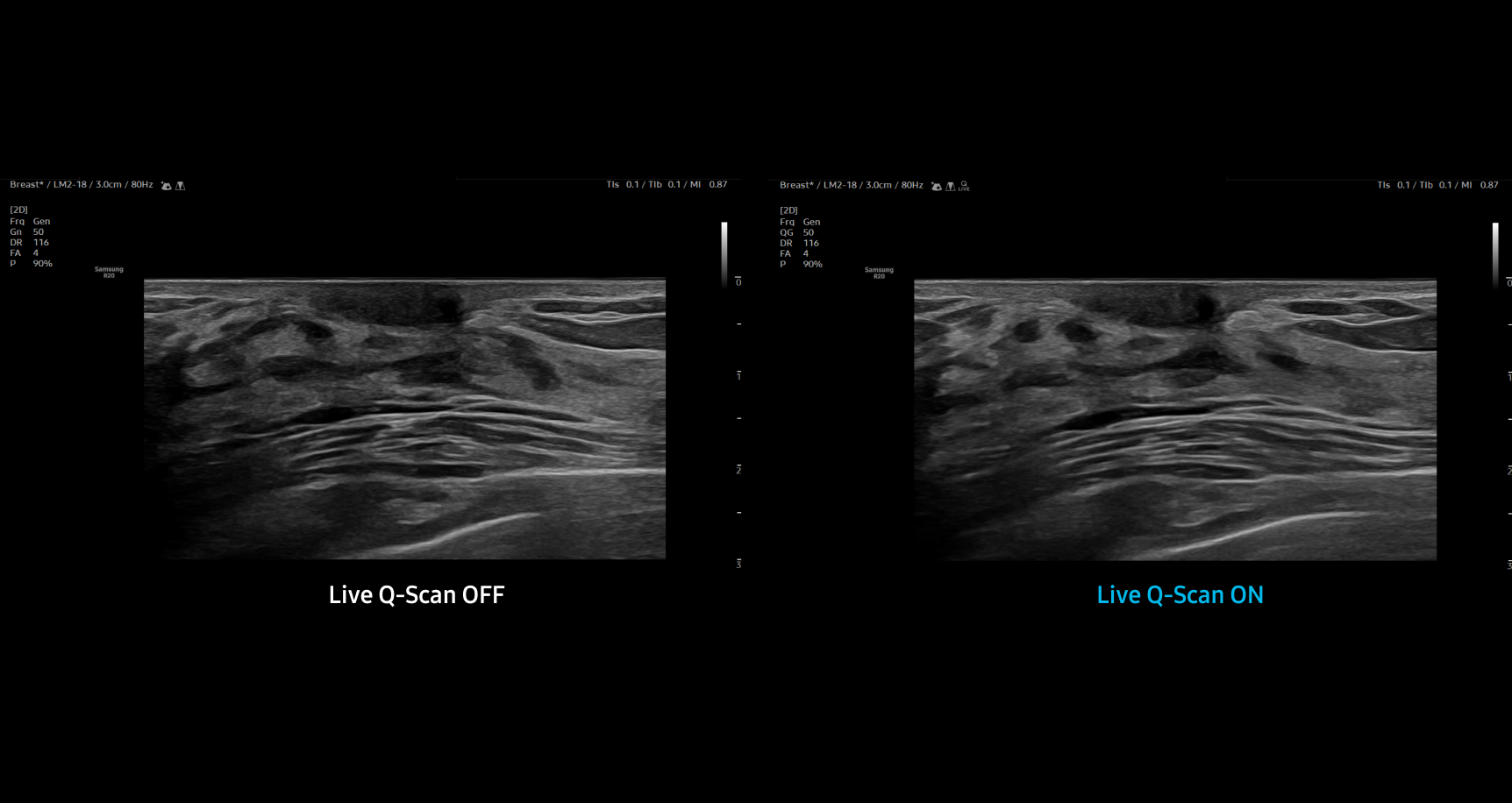 Side by side breast ultrasound images showing soft tissue structures with the left image labeled Live Q-Scan OFF appearing less clear and the right image labeled Live Q-Scan ON showing enhanced detail and improved tissue definition