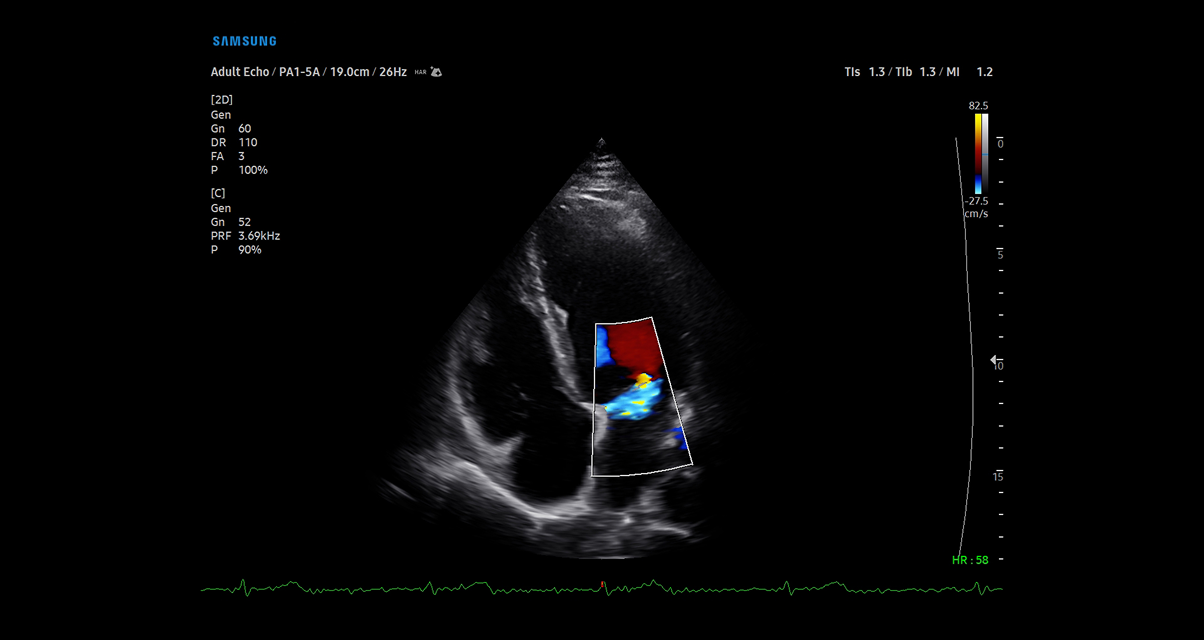 Samsung cV Ultrasound MR with color imaging technology displaying enhanced cardiovascular blood flow visualization with superior diagnostic detail