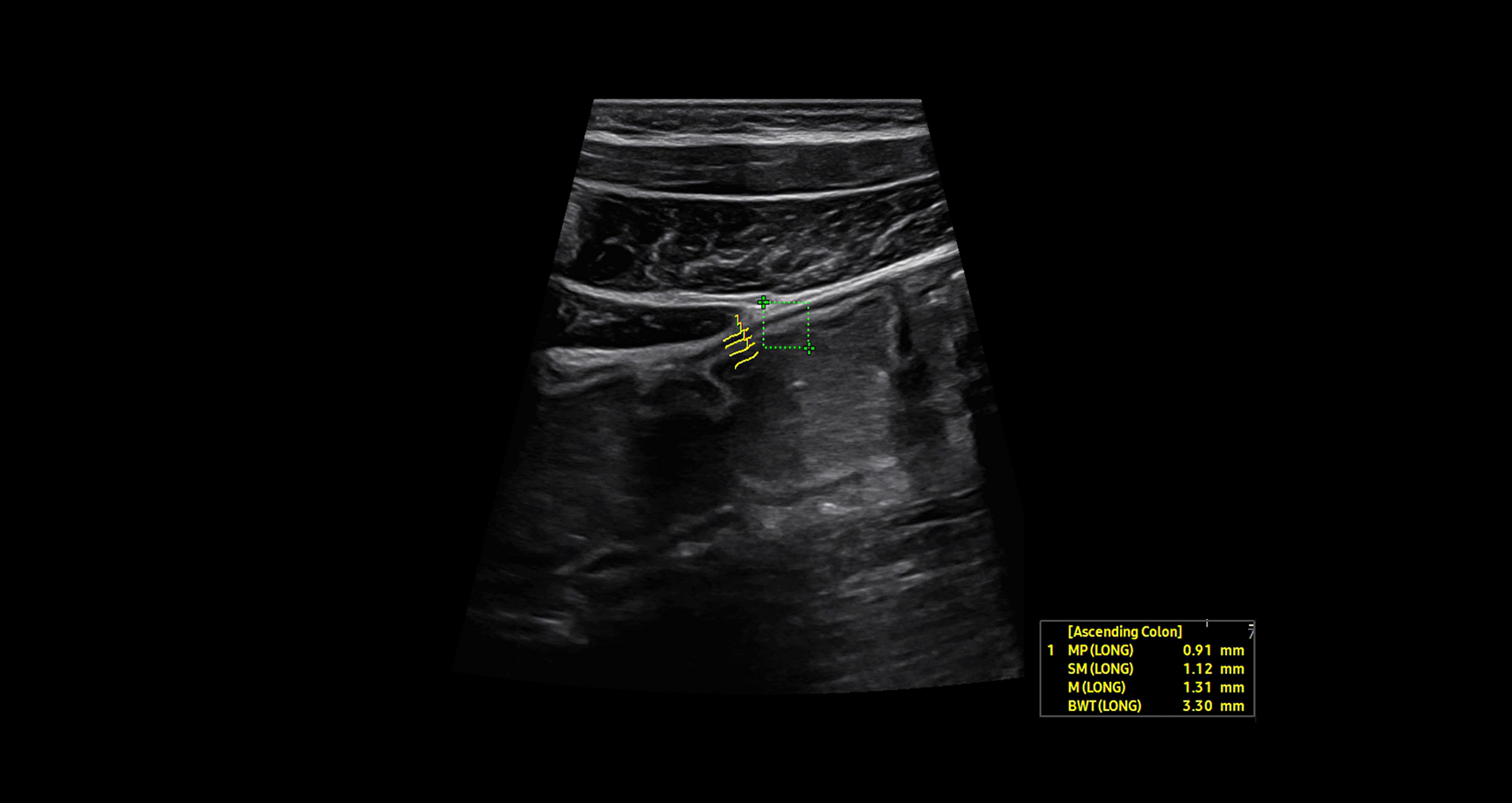 Ultrasound image of the bowel using BowelAssist showing real-time automated thickness measurements of bowel wall layers with yellow calipers and values displayed on screen for streamlined assessment