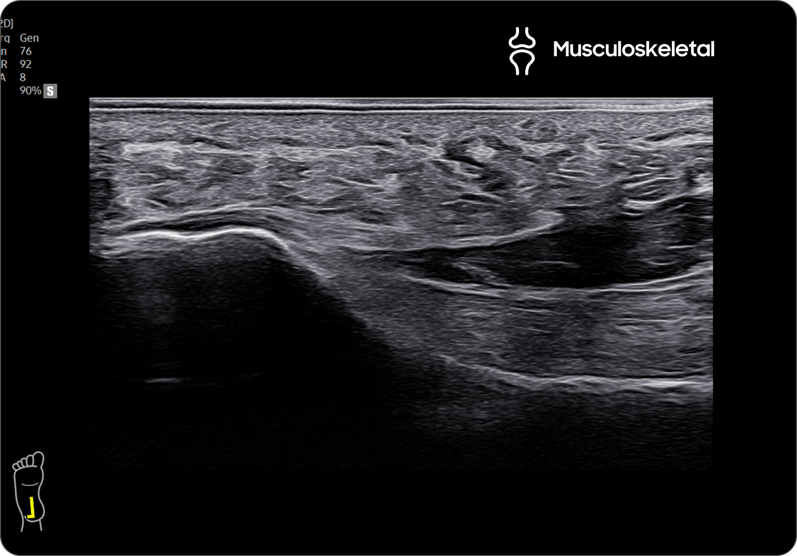 Ultrasound image of the plantar surface of the foot showing detailed muscle and connective tissue layers