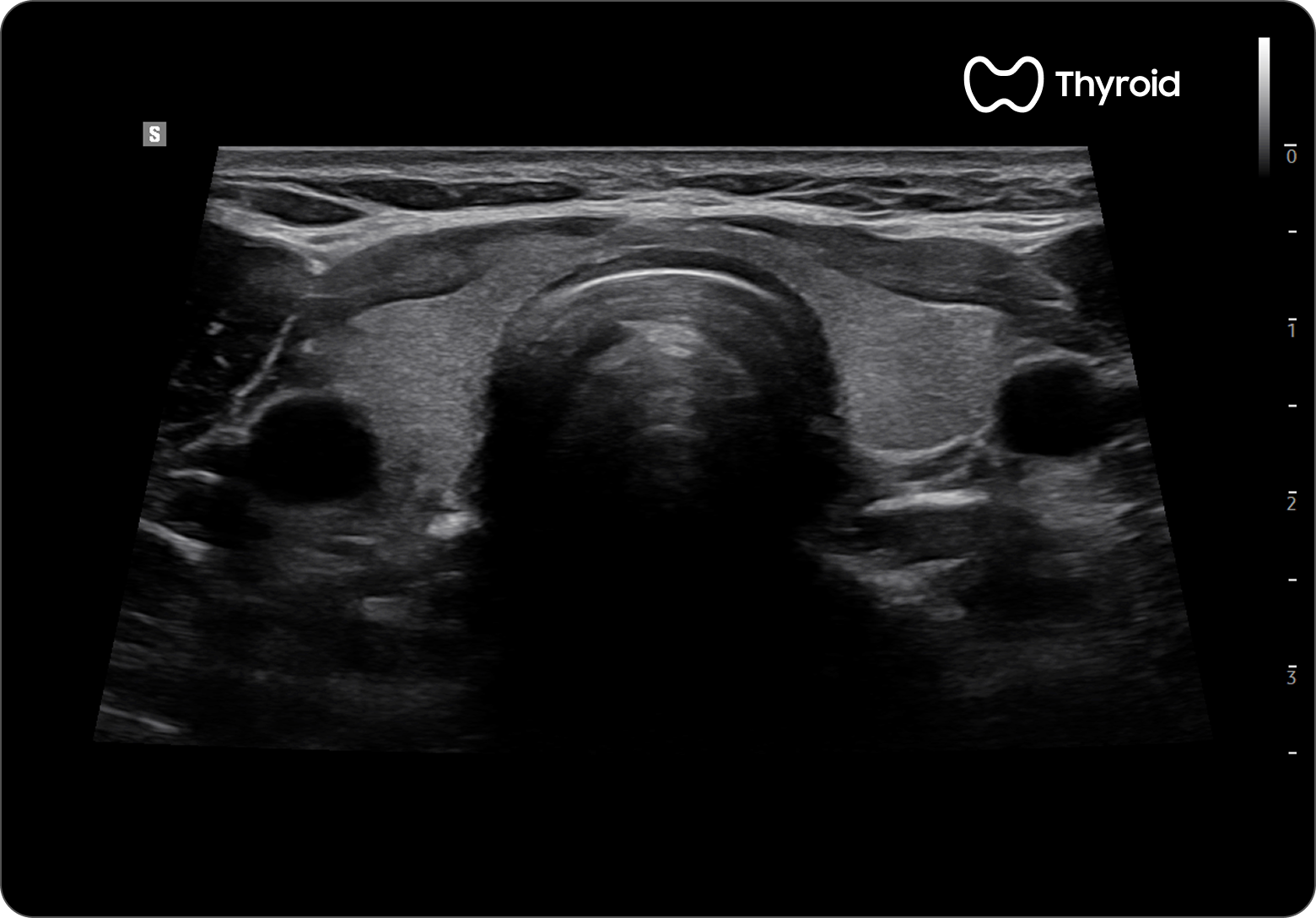 Thyroid ultrasound image in trapezoidal view showing the thyroid gland with surrounding neck structures