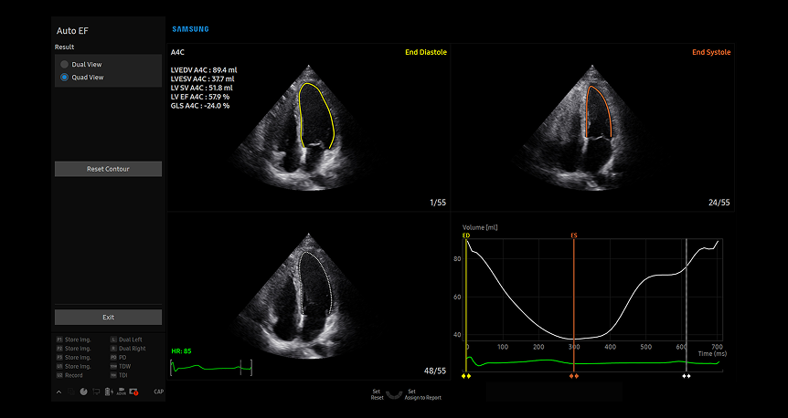 AutoEF cardiac assessment tool showing multi-view heart chamber visualization with automated ejection fraction measurements and volumetric analysis graph for quick diagnostic evaluation