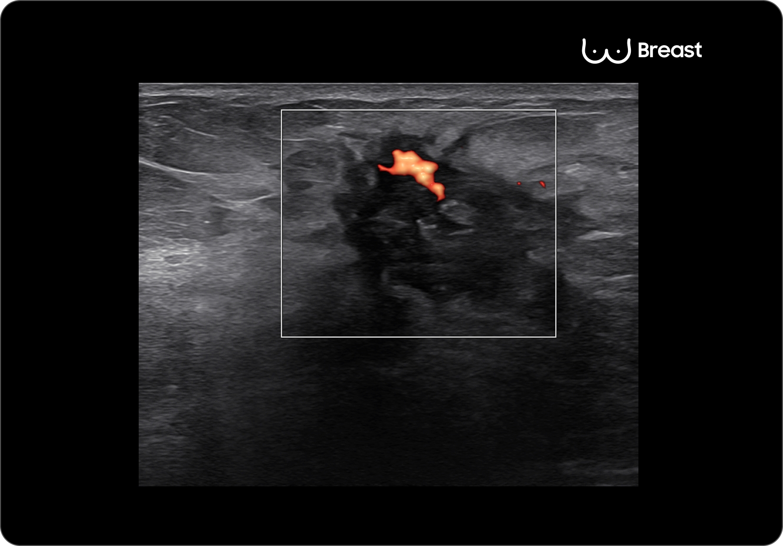 Breast ultrasound image showing an irregular hypoechoic mass with color Doppler flow in orange