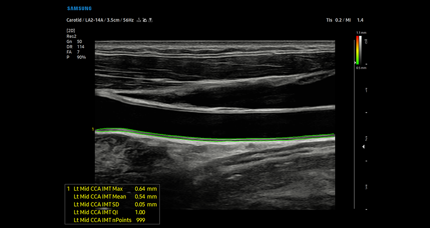 AutoIMT screening technology providing automated measurement of carotid artery intima-media thickness with precise quantification to assess cardiovascular disease risk factors
