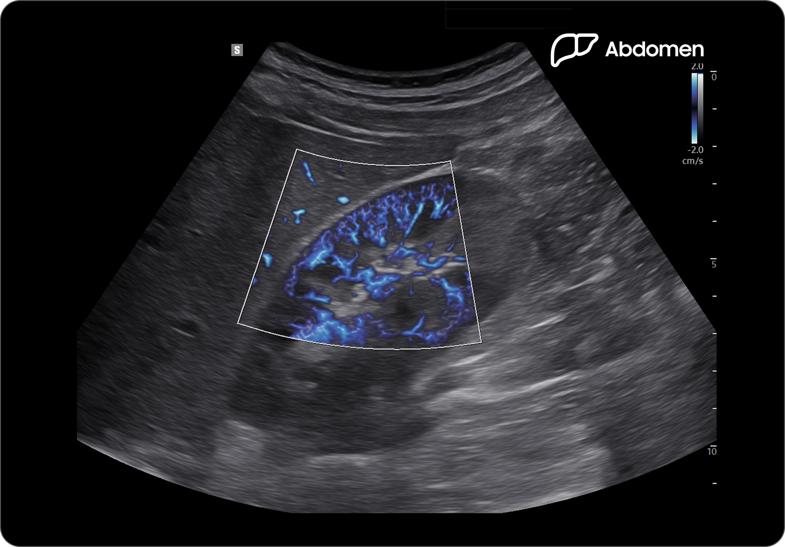 Ultrasound image of the kidney with MV-Flow showing blue vascular structures within the kidney parenchyma
