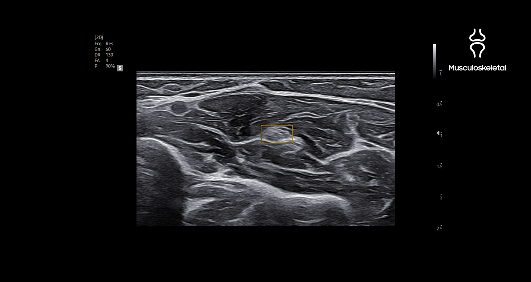 Musculoskeletal ultrasound image using NerveTrack showing a nerve area highlighted in a yellow rectangle with real-time detection and location information provided by deep learning technology