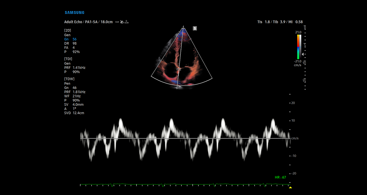 Samsung cV Ultrasound displaying Tissue Doppler Imaging with color flow mapping and spectral waveform analysis for advanced cardiovascular tissue motion assessment