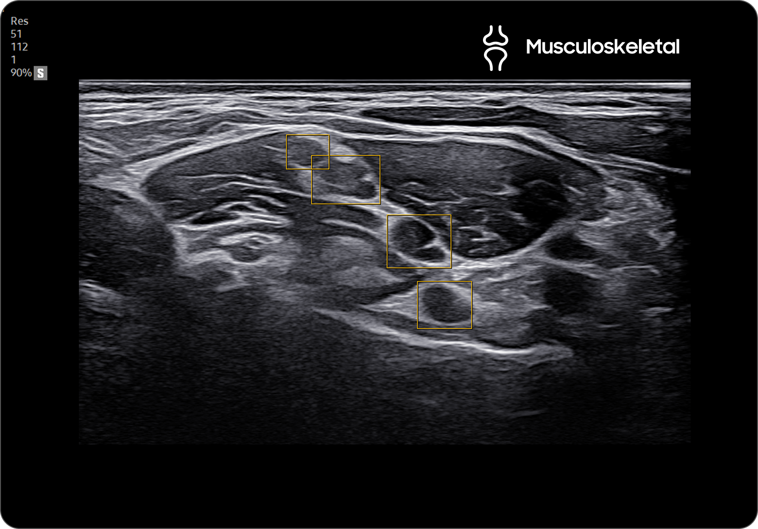 Ultrasound image of the brachial plexus with NerveTrack highlighting nerve pathways in yellow