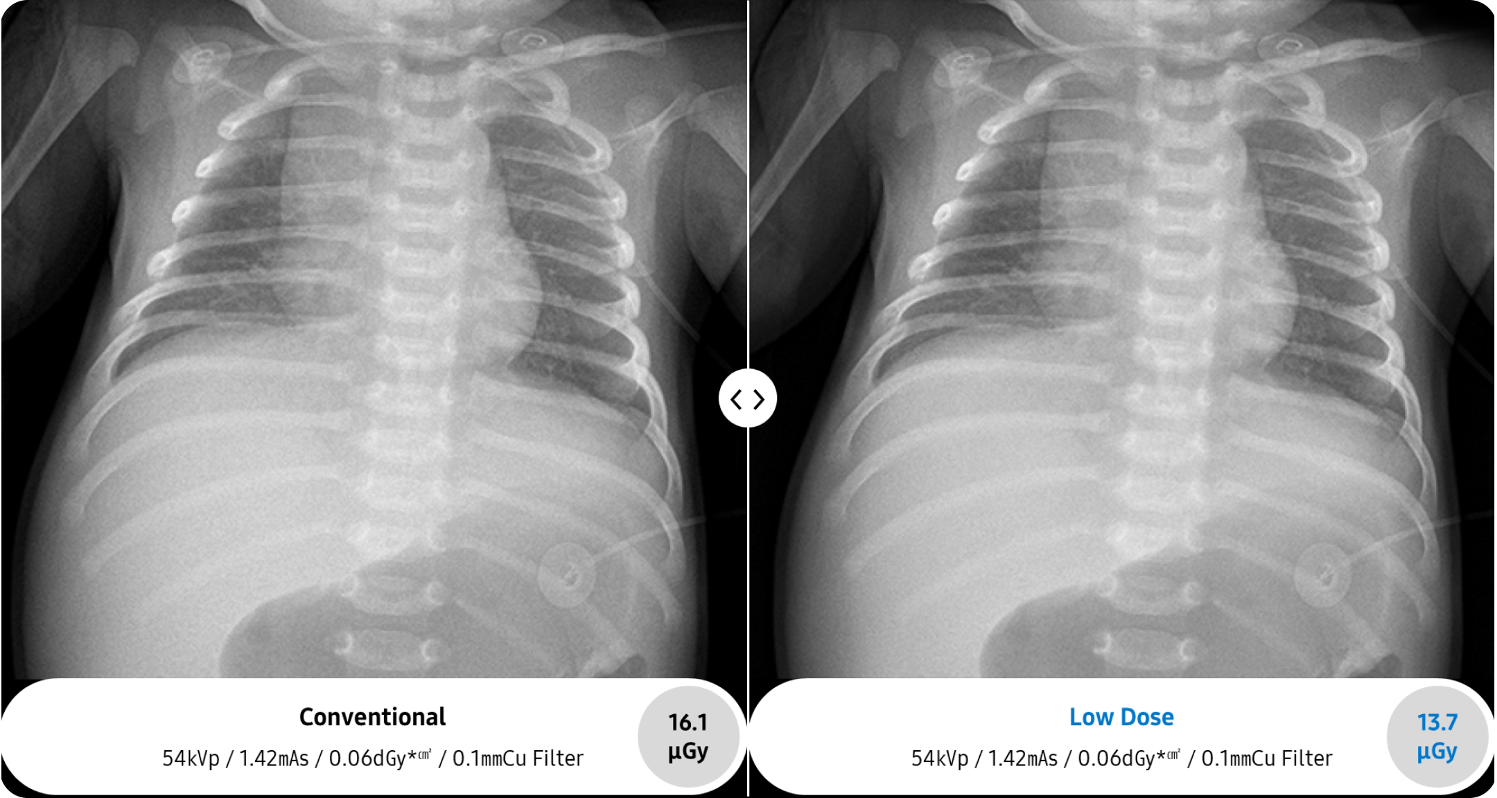 X-ray image of a pediatric chest taken by GM85 x-ray machine.