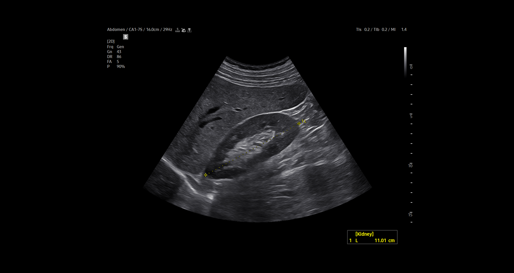 Ultrasound image of a kidney using AbdomenAssist showing automated measurement of kidney length with yellow calipers and annotation reducing user variability and simplifying workflow through deep learning technology