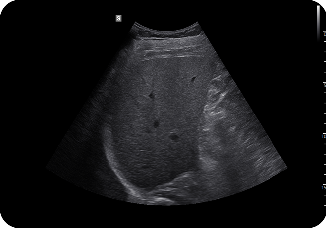 Ultrasound scan of the abdomen showing the liver in grayscale with internal vascular and tissue structures visible