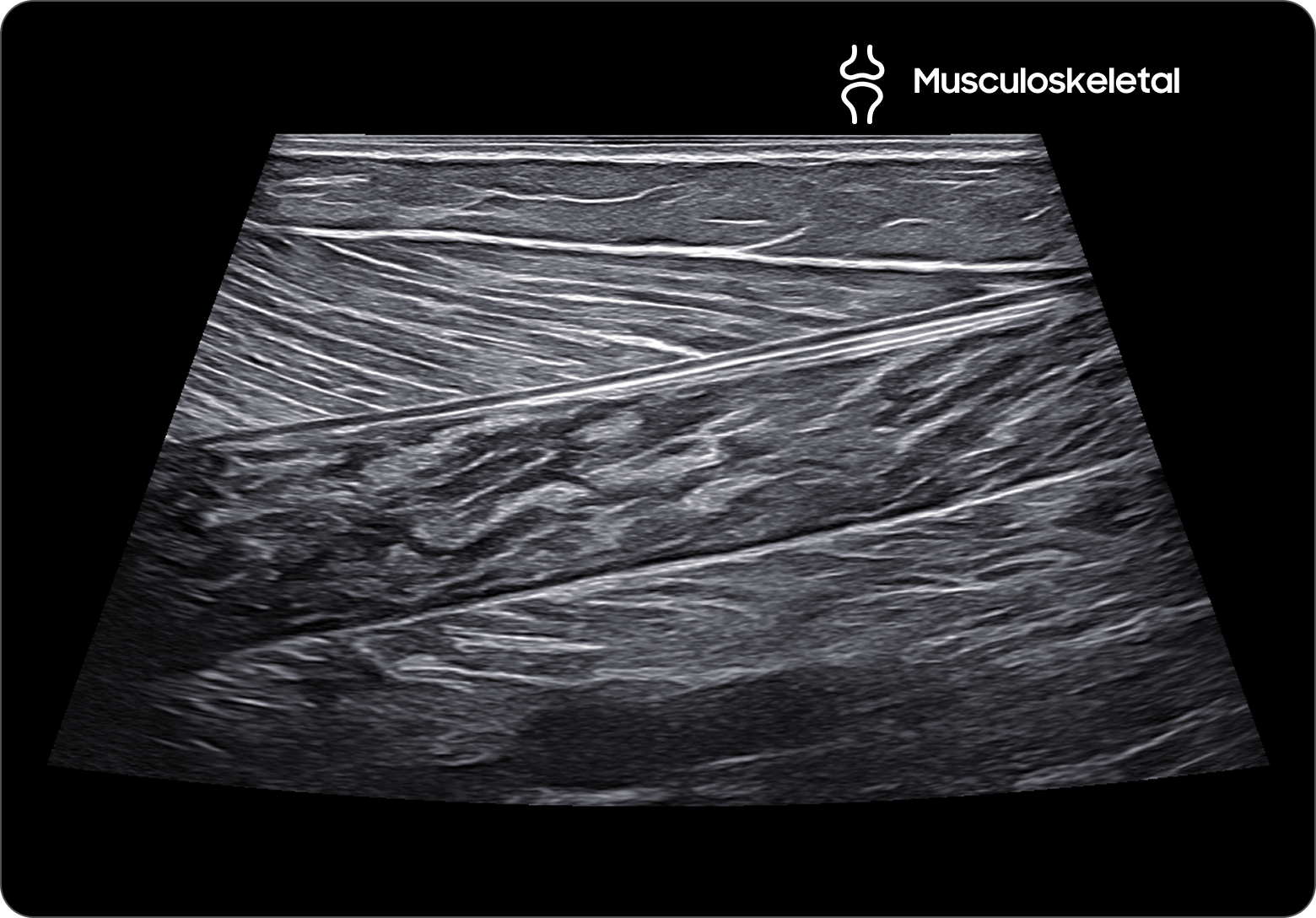 Ultrasound image of the calf with HQ-Vision showing clear muscle fibers and soft tissue structures