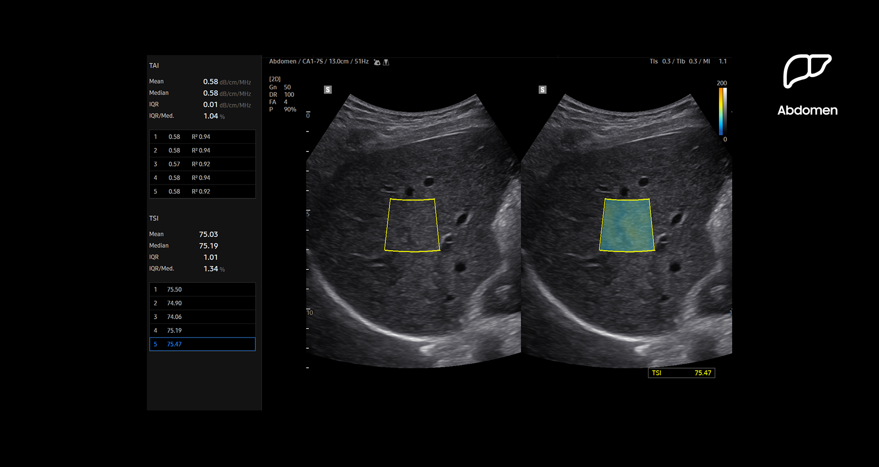 Dual-panel ultrasound image of the liver using TSI (Tissue Scatter distribution Imaging) showing regions of interest outlined in yellow with quantitative measurements displayed to assess steatotic liver changes